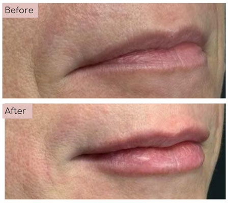 lip fillers before and afters